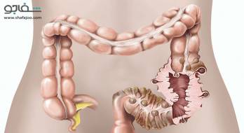 بیماری دیورتیکولی - Diverticular disease بیماری دیورتیکولی - Diverticular disease