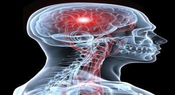 آنچه باید در مورد علائم سکته مغزی بدانیم آنچه باید در مورد علائم سکته مغزی بدانیم