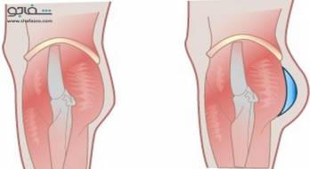مقایسه-تزریق-چربی-به-باسن-با-پروتز-باسن