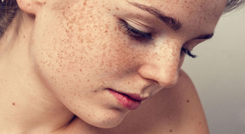 چگونه لکه های قهوه ای صورت را از بین ببریم؟ چگونه لکه های قهوه ای صورت را از بین ببریم؟