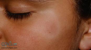 پیتریازیس آلبا - pityriasis alba. پیتریازیس آلبا - pityriasis alba.