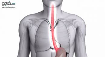 تنگی‌ مری‌ یا ازوفاژیت‌ خورنده‌ - es ophageal str icture or corrosive esophagitis