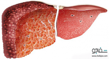 علل و علائم بیماری سیروز صفراوی اولیه علل و علائم بیماری سیروز صفراوی اولیه