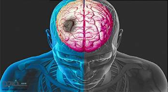 سکته مغزی - stroke سکته مغزی - stroke
