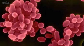 آمیوتروفیک لاترال اسکلروز (ALS) - Amyotrophic lateral sclerosis آمیوتروفیک لاترال اسکلروز (ALS) - Amyotrophic lateral sclerosis