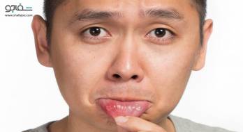 آفت دهان - canker sores آفت دهان - canker sores