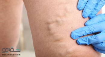ترومبوفلبیت - thrombophlebitis superficial ترومبوفلبیت - thrombophlebitis superficial