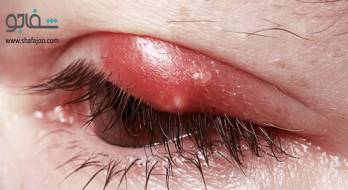 بلفاریت - blepharitis بلفاریت - blepharitis