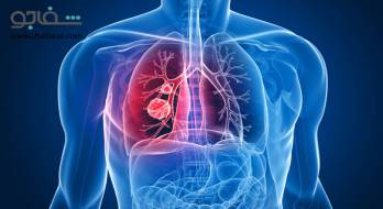 بیماری انسداد ریوی مزمن - chronic obstructive pulmonary disease بیماری انسداد ریوی مزمن - chronic obstructive pulmonary disease