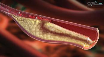 هیپرلیپیدمی - Hyperlipidemia هیپرلیپیدمی - Hyperlipidemia
