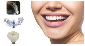 ایمپلنت دیجیتال انقلابی نوین در دندانپزشکی
