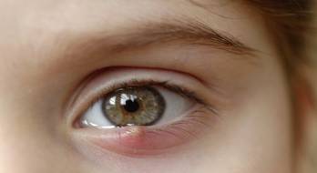 گل مژه - stye گل مژه - stye