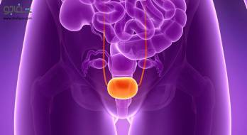 تومور مثانه - Bladder tumor تومور مثانه - Bladder tumor