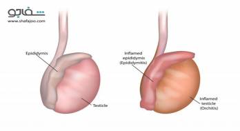 اپیدیدیمیت - Epididymitis اپیدیدیمیت - Epididymitis