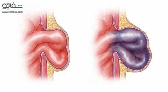 فتق هیاتال - Hiatal hernia فتق هیاتال - Hiatal hernia