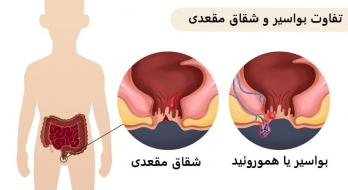تفاوت هموروئید با شقاق مقعد تفاوت هموروئید با شقاق مقعد