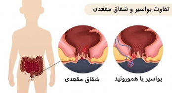 تفاوت هموروئید با شقاق مقعد