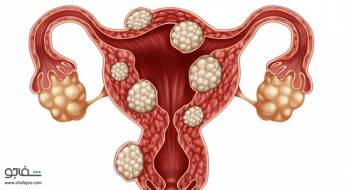 تومورهای فیبرویید رحم - Fibroid tumors of the uterus تومورهای فیبرویید رحم - Fibroid tumors of the uterus