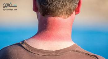 (آفتابزدگی (حساسیت به نور آفتاب) - sun poisoning (آفتابزدگی (حساسیت به نور آفتاب) - sun poisoning