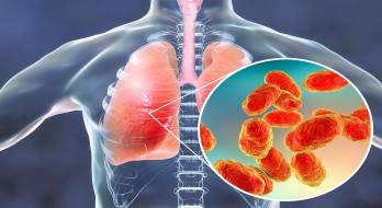 پنومونی‌ باکتریایی‌ - pneumonia bacterial
