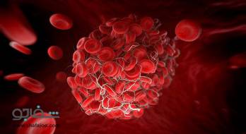 انعقاد داخل عروق منتشر - Disseminated intrar ascular coagulation انعقاد داخل عروق منتشر - Disseminated intrar ascular coagulation