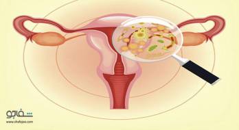 واژینیت مونیلیایی (عفونت قارچی مهبل) - vaginitis monilial واژینیت مونیلیایی (عفونت قارچی مهبل) - vaginitis monilial