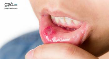 استوماتیت - stomatitis استوماتیت - stomatitis