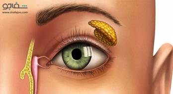 عفونت یا انسداد مجرای اشکی - tear duct infection or blockage عفونت یا انسداد مجرای اشکی - tear duct infection or blockage