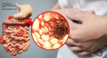 بیماری کرون - Crohn's disease بیماری کرون - Crohn's disease