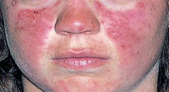 علائم بیماری لوپوس چه چیزهایی هستند؟ علائم بیماری لوپوس چه چیزهایی هستند؟