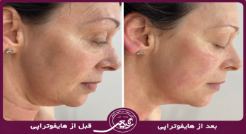 با روش هایفوتراپی صورت تا 20 سال جوان تر شوید! با روش هایفوتراپی صورت تا 20 سال جوان تر شوید!