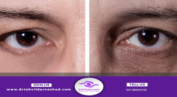 بررسی علل فرورفتگی دور چشم + نحوه درمان آن بررسی علل فرورفتگی دور چشم + نحوه درمان آن