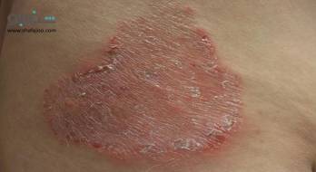 اسپوروتریکوز - sporotrichosis اسپوروتریکوز - sporotrichosis