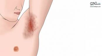 هیدرآدنیت چرکی - Hidradenitis suppurativa هیدرآدنیت چرکی - Hidradenitis suppurativa
