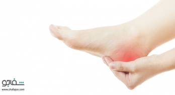 خار پاشنه پا - Heel spur خار پاشنه پا - Heel spur