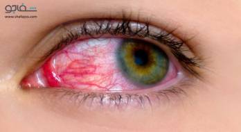 خونریزی زیر ملتحمه - subconjunctival hemorrhage خونریزی زیر ملتحمه - subconjunctival hemorrhage