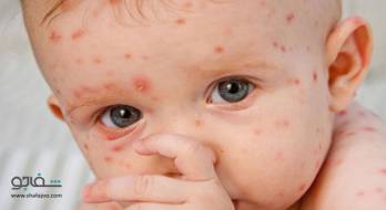 آبله مرغان - chickenpox آبله مرغان - chickenpox