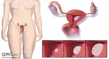 سرطان مهبل یا وولو - cancer of vagina or vulva سرطان مهبل یا وولو - cancer of vagina or vulva