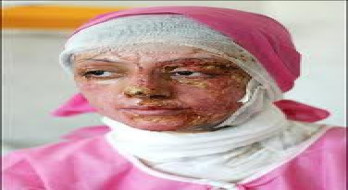 قربانی اسیدپاشی حداقل به 60 عمل جراحی نیاز دارد، دولت موظف است هزینه ها را تأمین کند قربانی اسیدپاشی حداقل به 60 عمل جراحی نیاز دارد، دولت موظف است هزینه ها را تأمین کند