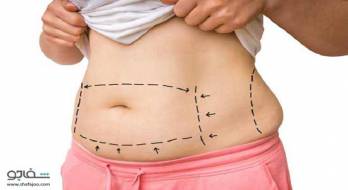 چگونه-چاقی-را-درمان-کنیم-جراحی-چاقی-شکم-و-پهلو-تامی-تاک-یا-آبدومینوپلاستی