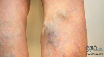 ترومبوز ورید عمقی‌ - thrombosis deep vein