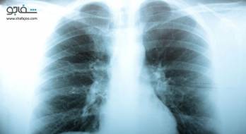 آمفیزم - Emphysema آمفیزم - Emphysema
