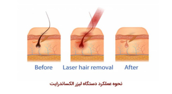 دستگاه لیزر الکساندرایت و کاربردهای آن