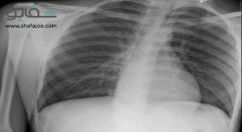 پنوموتوراکس‌ - pneumothorax