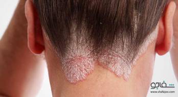 پسوریازیس‌ - psoriasis