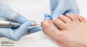 فرو رفتن ناخن پا در گوشت - toenail ingrown فرو رفتن ناخن پا در گوشت - toenail ingrown