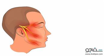 درد عصب سه قلو (نورالژی تری ژمینال) - trigeminal neuralgia درد عصب سه قلو (نورالژی تری ژمینال) - trigeminal neuralgia