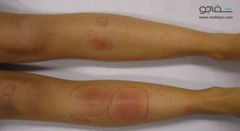 اریتم گرهی - Erytheerythema nodosum. اریتم گرهی - Erytheerythema nodosum.