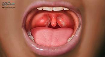 گلودرد استرپتوکوکی - strep throat گلودرد استرپتوکوکی - strep throat