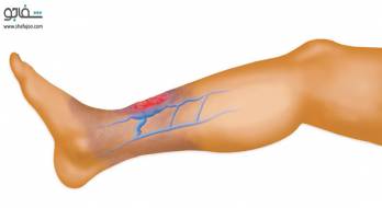 وریدهای واریسی - varicose veins وریدهای واریسی - varicose veins